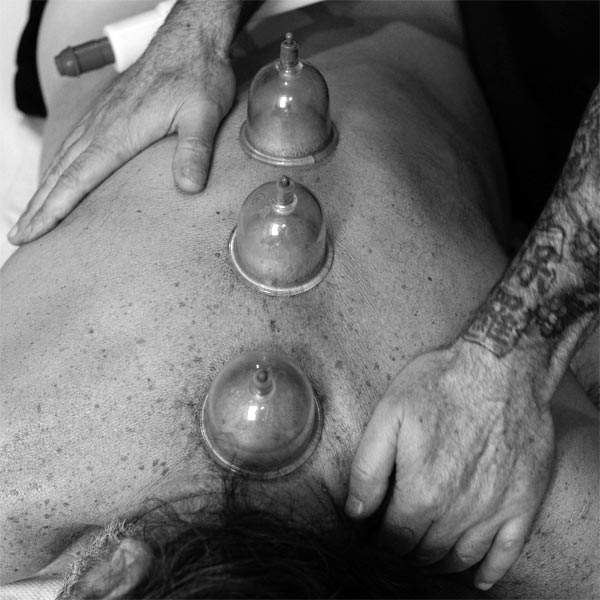 Coppettazione